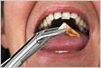É normal após a extração do dente do siso não conseguir abrir a
